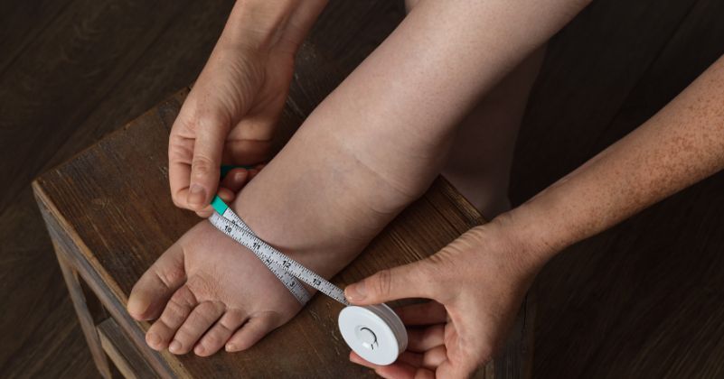 Linfedema alle gambe, tra i sintomi anche gonfiore localizzato e senso di pesantezza