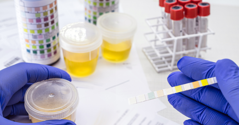 Leucociti nelle urine cosa indicano